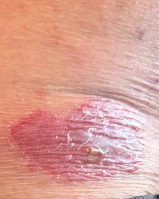 Cropped abdomen photograph labelled 6 July, showing a textured skin patch