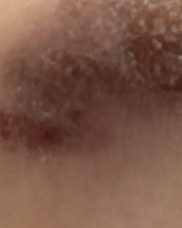 Close crop of chin skin in the photograph labelled 1 August