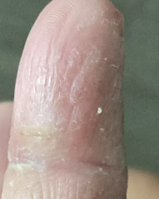 Close crop of the same finger in the photograph labelled 18 August