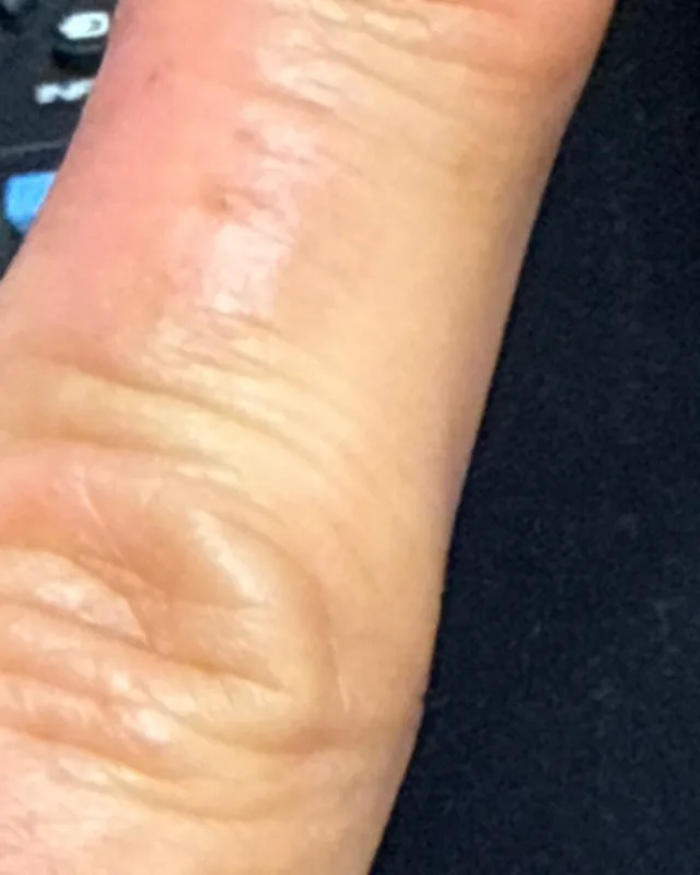 Close crop of the same finger in the Day 28 photograph