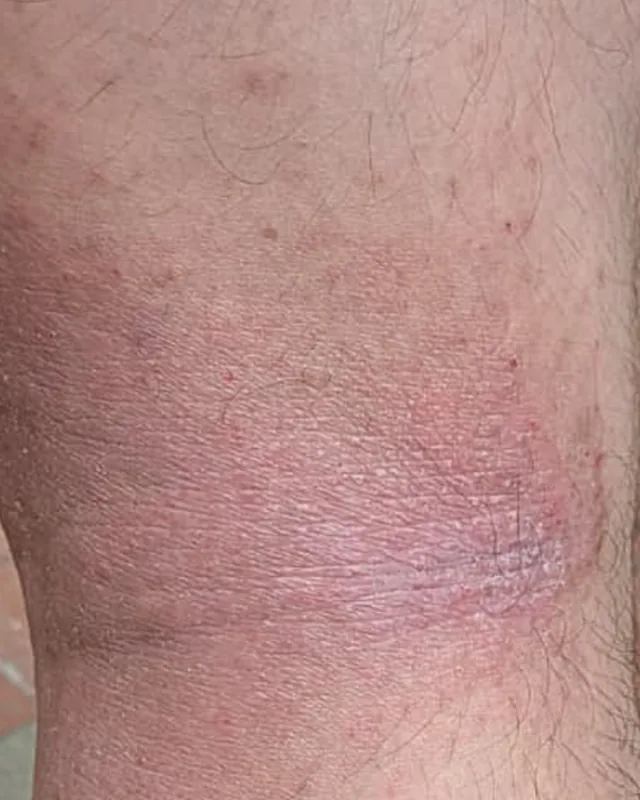 Close crop of skin behind the knee in the Day 0 photograph