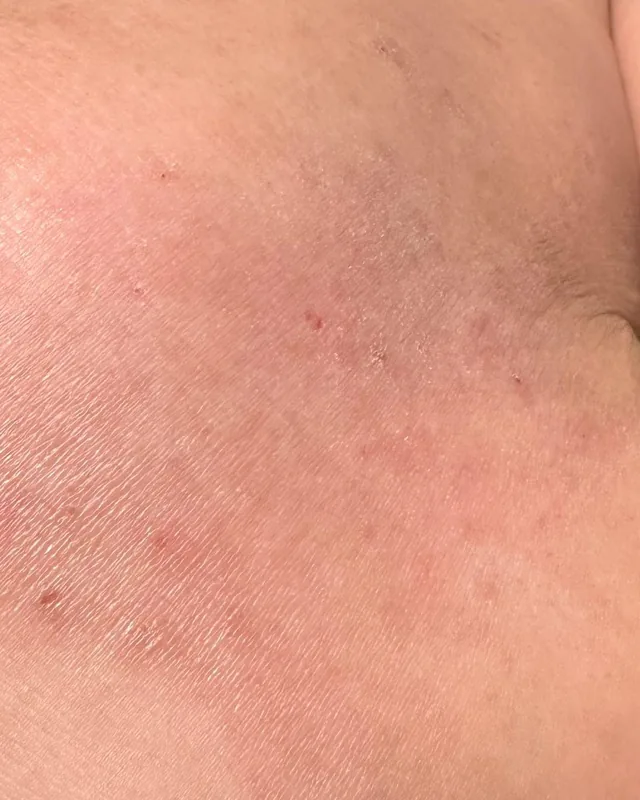 Close crop of an upper-arm area in the 18 July photograph
