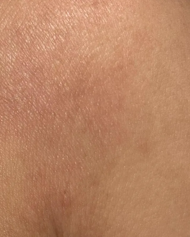 Close crop of an upper-arm area in the 10 August photograph