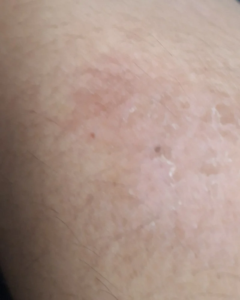 Skin-only crop of the same upper-arm area on 24 September in different light